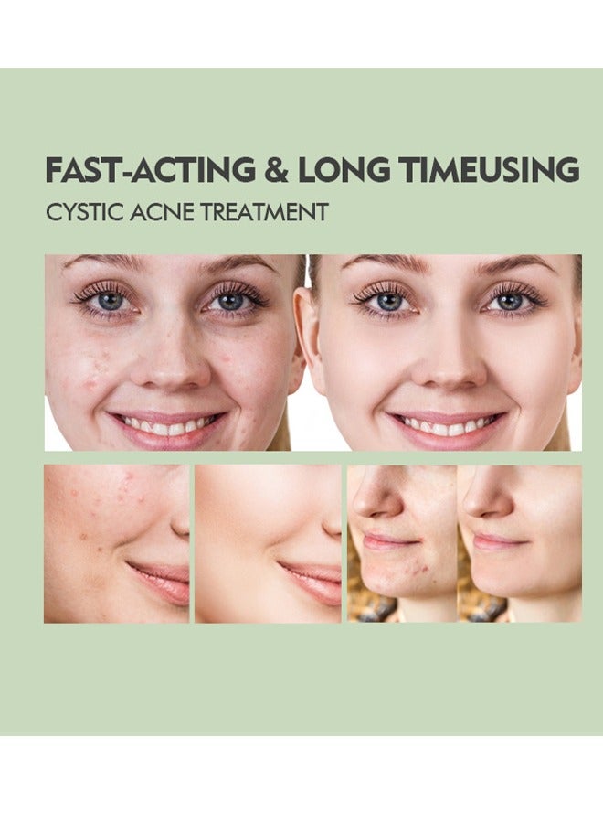 Acne Control Gel-Salicylic Acid Remove Acne Gel Lighten Acne Marks Remove Acne Shrink Pores Plant Essence - Fast Acne Removal in 12 Hours to See Results