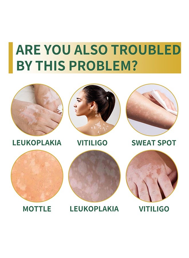 سوميفون كريم تخفيف البهاق ، علاج مرهم البهاق للبشرة ، يتلاشى البقع البيضاء ويحسن كريم تصبغ البشرة ، كريم البهاق للعناية الصحية بالبشرة 20 جرام - Image 3