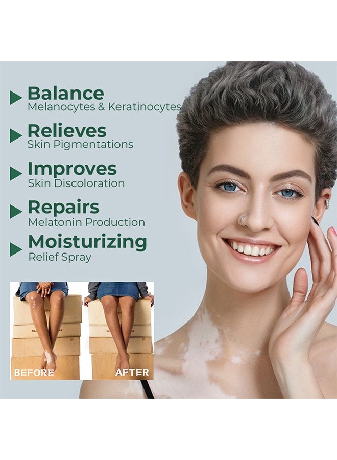 سوميفون كريم تخفيف البهاق ، علاج مرهم البهاق للبشرة ، يتلاشى البقع البيضاء ويحسن كريم تصبغ البشرة ، كريم البهاق للعناية الصحية بالبشرة 20 جرام - Image 2