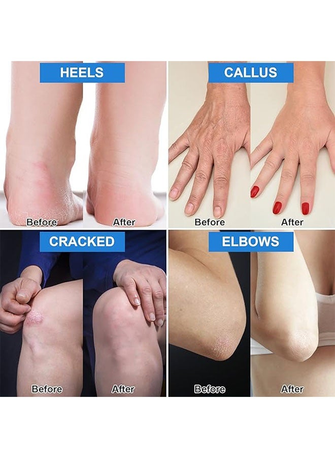ISSUWEN Urea Cream 42% + Salicylic Acid 2% 100g, Foot Cream for Dry Cracked Heels Knees Elbows Hands Repair Treatment, Foot Moisturizer for Dead Skin Remover Toenail Softener, Foot Care - Image 3