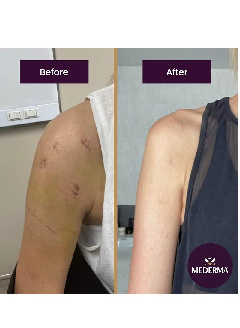 Mederma Advanced Scar Gel 1x Daily Reduces The Appearance Of Old New Scars / Doctor Pharmacist Recommended Brand for Scars , Clear, 20 grams