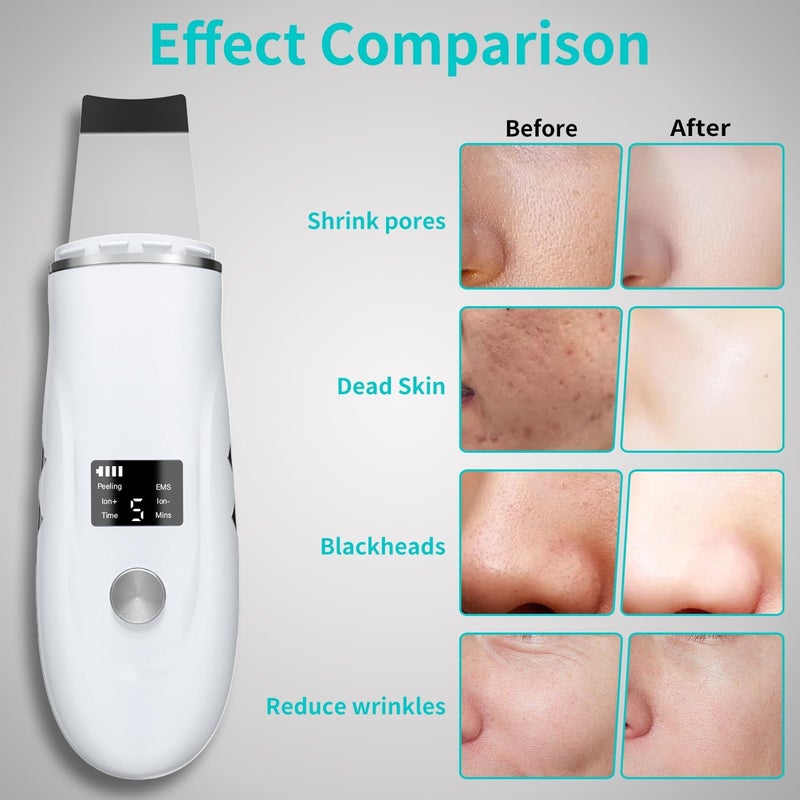 4 in 1 rechargeable blackhead shovel, pore cleaning and exporting instrument (white) - Image 3