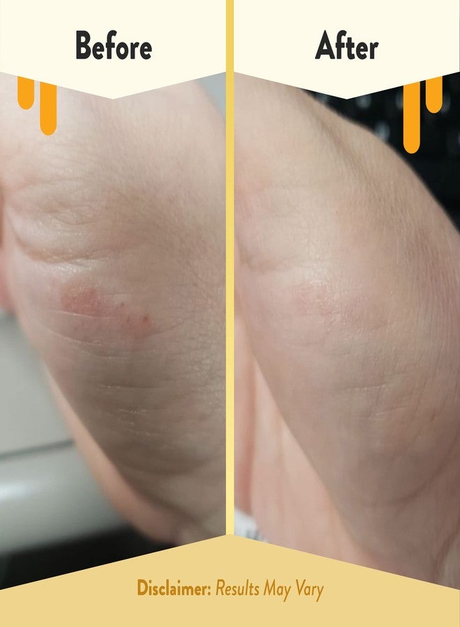 ECZEMA HONEY Itch Cooling Face & Body Rounds - Anti Itch Cotton Face Pads - Moisturizer for Eczema, Dry & Sensitive Skin (50 Cotton Rounds) - Image 4