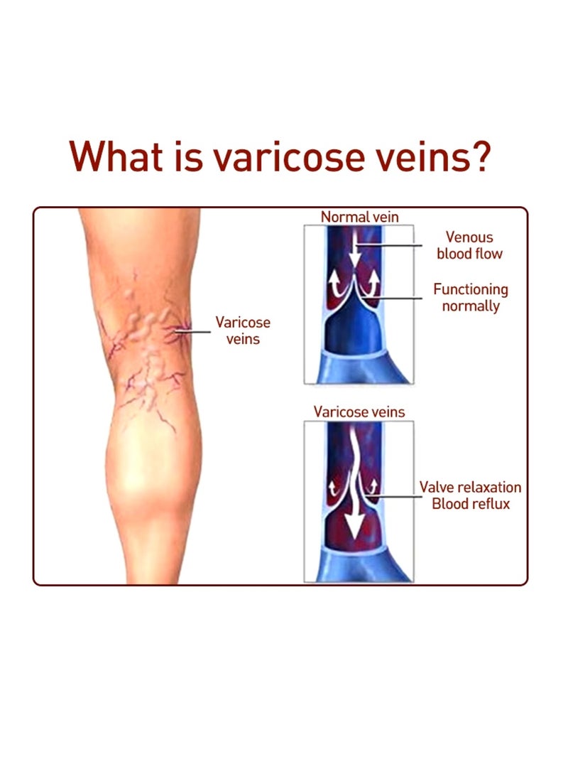 Varicose Veins Cream Improve Spider Veins and Blood Circulation Eliminate the Appearance of Varicose Veins Vein Inflammation Treatment Relieve Swelling and Pain Spider Veins Treatment Cream 20g
