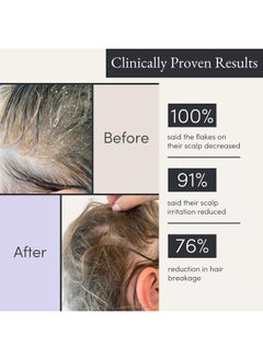JUPITER Anti Dandruff Shampoo For Women & Men Physician Formulated For Flaky Itchy Oil Dry Scalp Treatment Vegan Sulfate Free Color Safe & Paraben Free Scalp Psoriasis Shampoo With Zinc  - Image 5