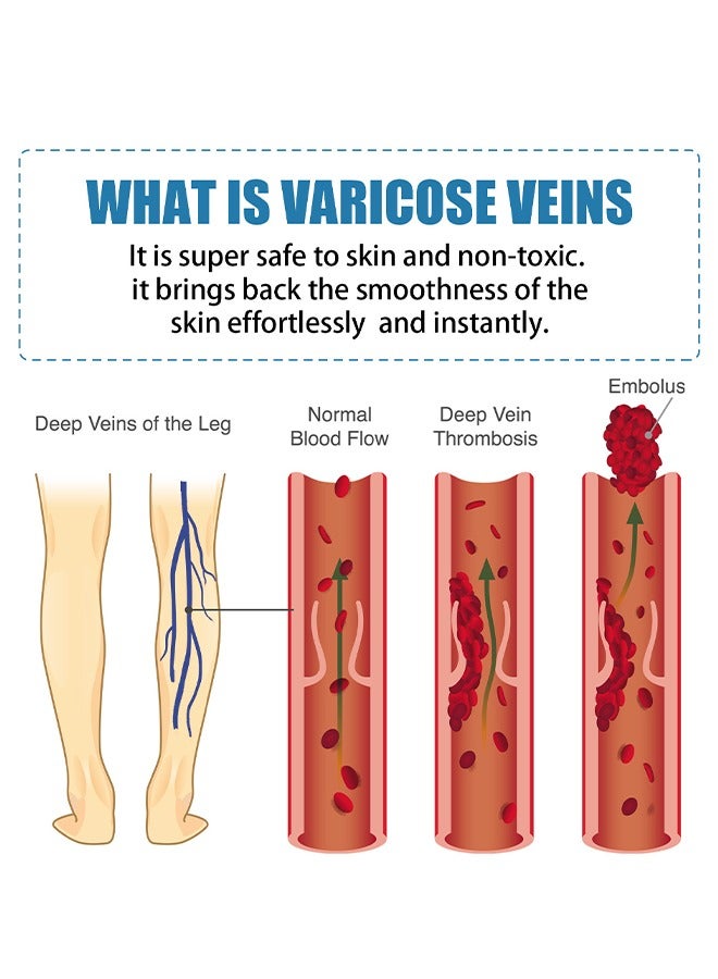 OUHOE Varicose Veins Soothing Cream, Soothing Leg Cream, Varicose and Spider Veins Treatment Cream, Improve Blood Circulation, Fast Relieve Swelling Pain 20g  - Image 5