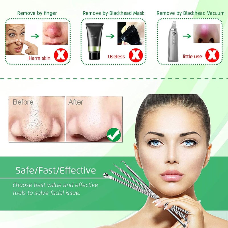 Faigy 4PCS Blackhead Remover Comedone Extractor, Curved Blackhead Tweezers Kit, Professional Stainless Pimple Acne Blemish Removal Tools Kit - Image 2
