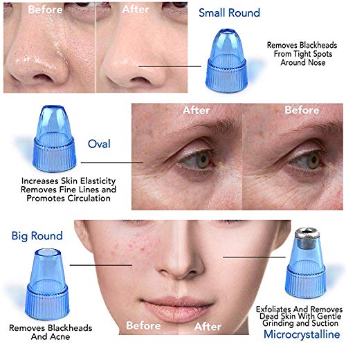 Smars® Portable Multi Function Blackhead Remover Vaccum Pimple Sucker for Men & Women Blackheads Remover Tool Kit, Acne Remover, Pore Cleaner, Facial Beauty Care - Image 4
