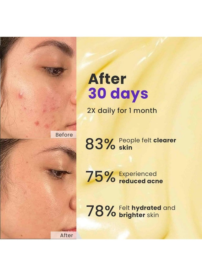 Saffr'n Acne Erase Cream with Saffron, 5% Niacinamide, Peptide, Nano Silver, Nano ZnO, Stem Cells for Clear Acne Free Skin | 50 ml - Image 3