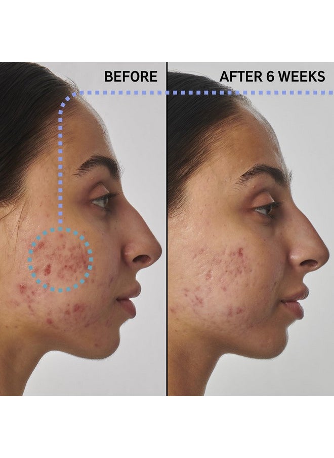 The Inkey List Supersolutions 1% Retinol Serum For Face And Neck Helps With Scar Wrinkle And Skin Tone Appearance For Healthylooking Skin 1.01 Fl Oz  - Image 2