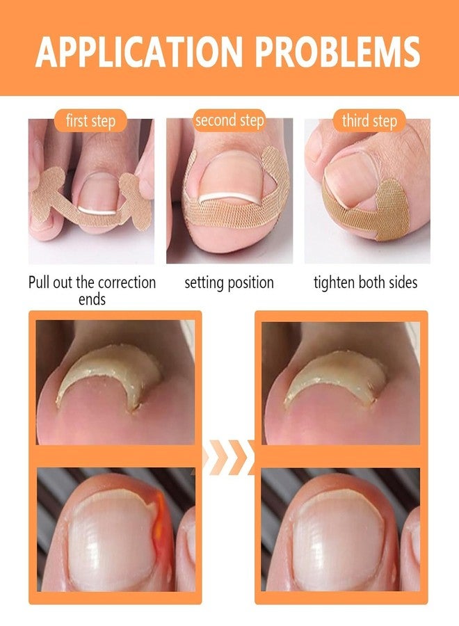 Wisik enterprise 5 pcs Ingrown Toenail Patch | Portable Comfortable Double-ended Tool Nail Support Breathable Foot Care Patch for women, men | Nail Correction Stickers for Nail Correction - Image 5