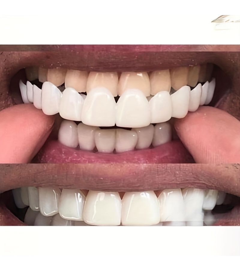 Set Of 2 White Comfortable Dental Protectors Upper And Lower Easy To Use - Image 2