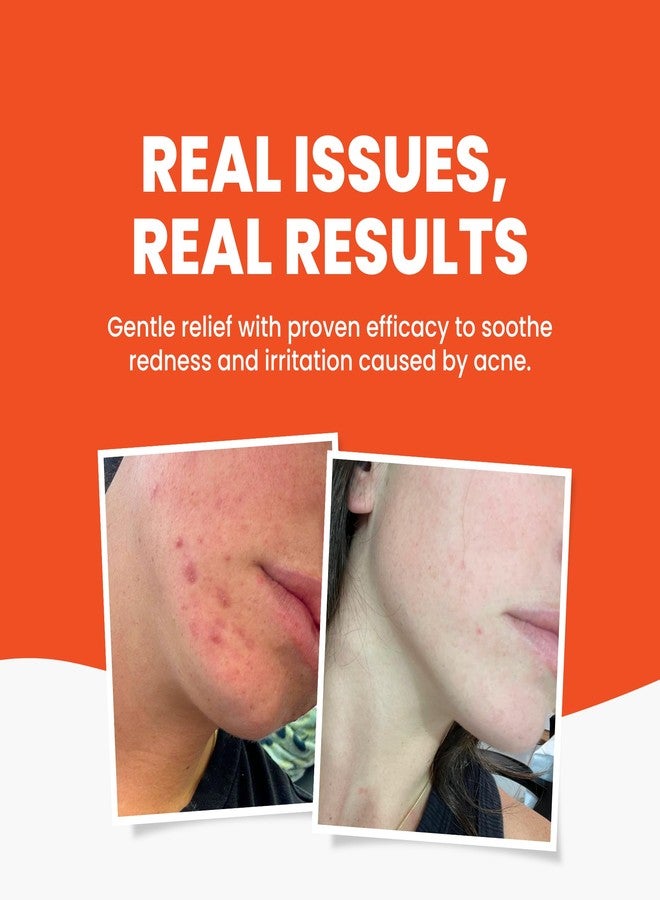 Grahams Natural Acne Gel Morning & Night Spot Treatment Pimple Cream for Face, Back & Body - All Natural with Witch Hazel, Honey, Aloe Vera, for Oily Skin & Blemish Control (1.06 oz) - Image 3