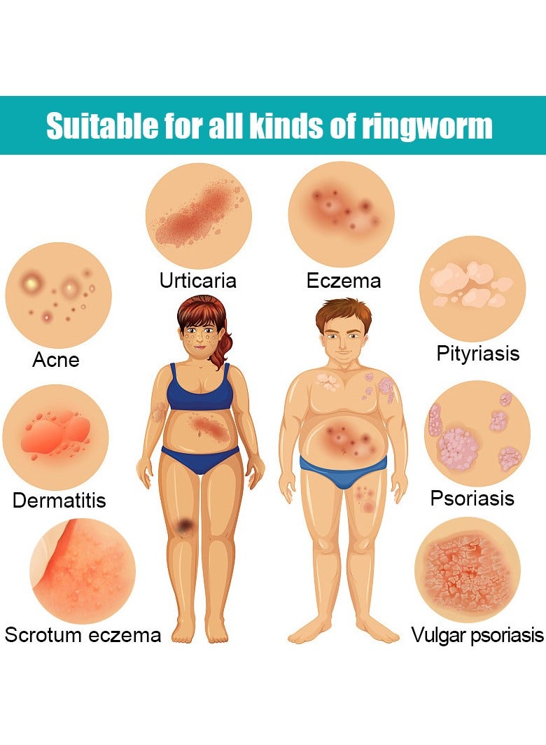 KanyeHB Eczema Cream, Maximum Strength Ointment for Rashes, Psoriasis, Dermatitis, Hives, Ringworm, Jock itch, Fungal Infections, Anti-itch, Relief- 20g - Image 2