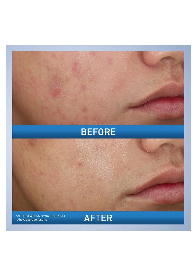 Acne Foaming Cream Wash 150ml
