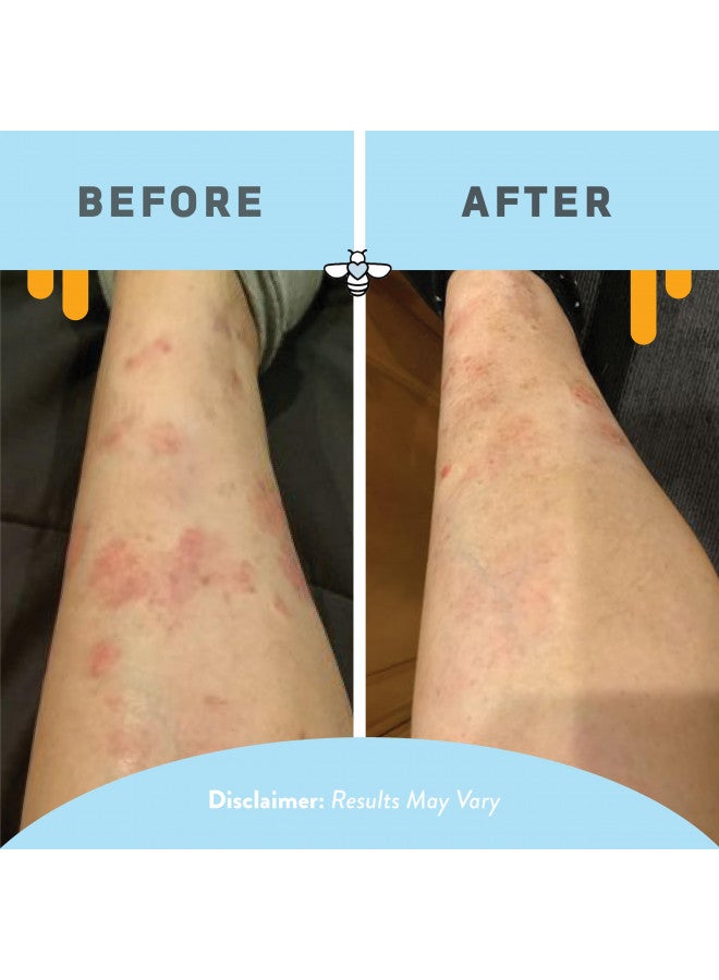 PSORIASIS HONEY PSORIASIS HONEY Daily Moisturizing Body Lotion - Anti-Itch Day & Night Cream - Psoriasis Treatment for Skin - Ointment for Itch Relief - Psoriasis Cream Helps Dry Skin (16oz) - Image 5