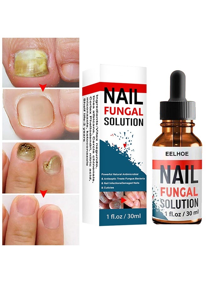 EELHOE Nail Fungal Solution,Fungal Nail Treatment For Toe Nail And Fingernails- Repair Solution For Thick/Broken/Discolored Nails-Renews Damaged Cracked Ingrown Toenail 30ml - Image 1