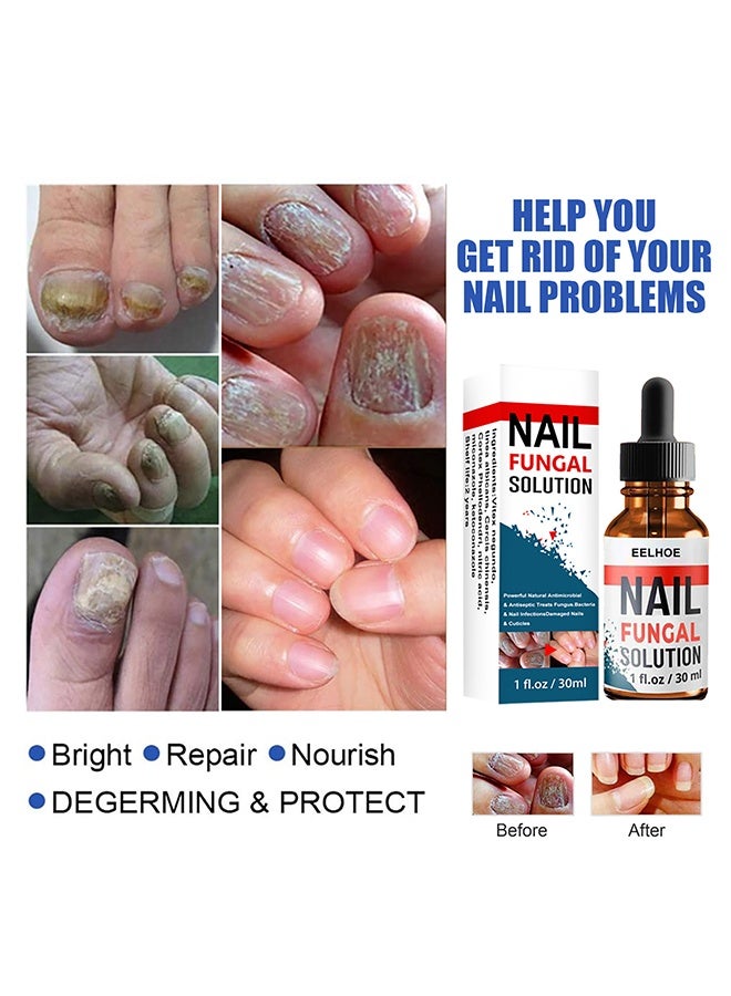 EELHOE Nail Fungal Solution,Fungal Nail Treatment For Toe Nail And Fingernails- Repair Solution For Thick/Broken/Discolored Nails-Renews Damaged Cracked Ingrown Toenail 30ml - Image 4