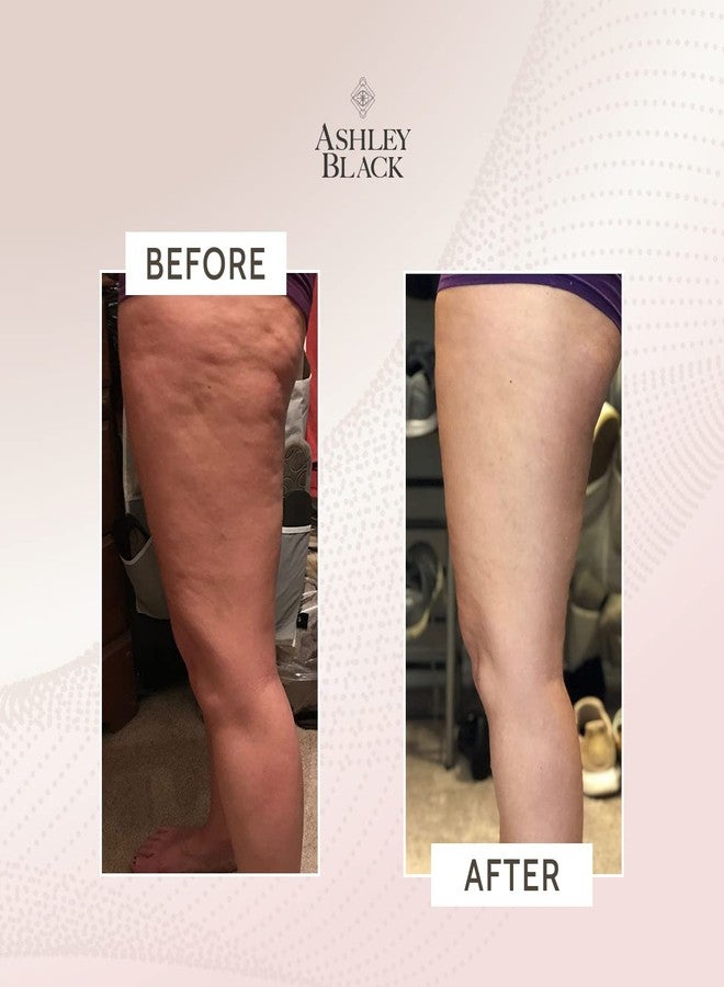 FasciaBlaster جهاز فاشيا بلاستر برو بلاستر المحمول من آشلي بلاك. أدوات علاجية مثبتة علميًا لعلاج الأنسجة العضلية. تدليك لطيف بنتائج فعالة. يخفف توتر الجسم بالكامل ويحارب السيلوليت. - Image 3