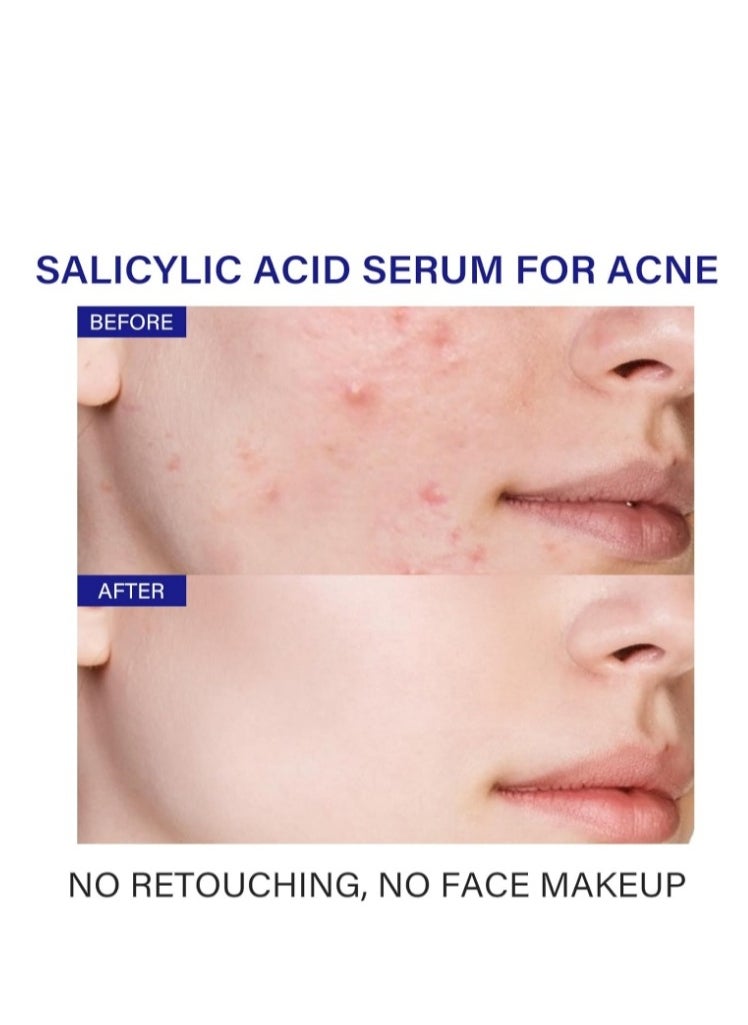 MOOYAM - 2% Salicylic Acid Serum For Face Acne Treatment, Acne Serum For Oily Skin, Moisturizer Face Serum for Acne Spot, Blackhead Whitehead Remover, Pore Reducer, Acne Skincare For Women Men - Image 1