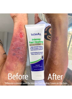 TriDerma TriDerma Intense Fast Skin Healing Cream for Hard-to-Heal Skin Irritations, Sores, Rashes, Dry, Cracked Hands, Cuts, Chafing, Burns, Scrapes - First Aid Kit Essential - FSA Eligible - 4.0 oz Tube  - Image 3