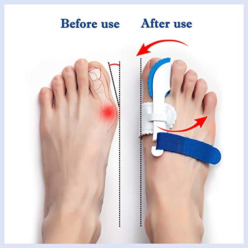 ERSANLI Bunion Corrector Brace for Pain Relief, Hallux Valgus Corrector & Big Toe Joint Support – Adjustable Night Splint for Men and Women, Comfortable Bunion Valgus Protective Cover (2Pcs) - Image 5