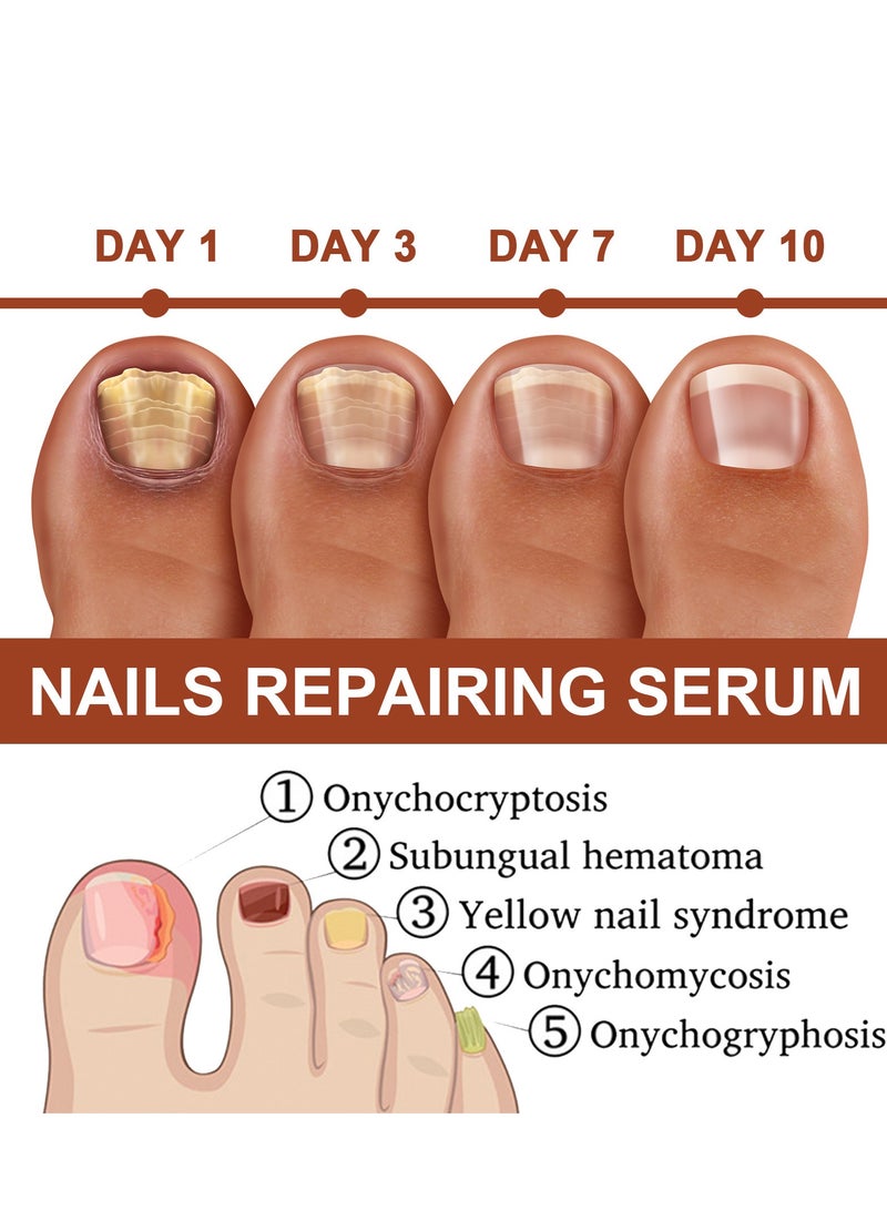 جايسوينغ زيت خلاصة إصلاح الأظافر، مصل مكثف لنمو الأظافر وقوتها، خلاصة مرطبة لعلاج فطريات الأظافر للعناية بالقدمين واليدين، سائل مضاد لالتهاب أظافر القدمين لإزالة الفطريات - Image 2