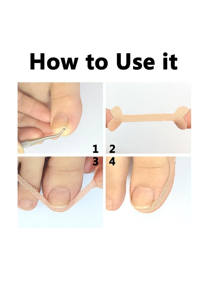 Ba Love Ingrown Toenail Treatment Strips, 40 Pcs Toe Nail Correction Patch Elastic Patch Sticker Corrector Pedicure Tools, Professional Glue-Free Toe Nail Treatment Tool, Foot care - Image 3