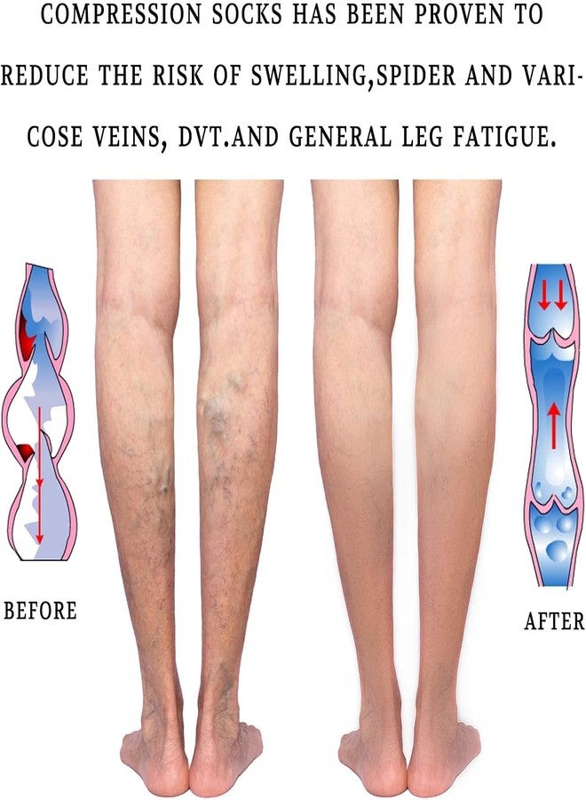 Dr Helix Varico Vein Compression Stocking Thigh High, Open Toe Support Sock - (XL) - Image 5