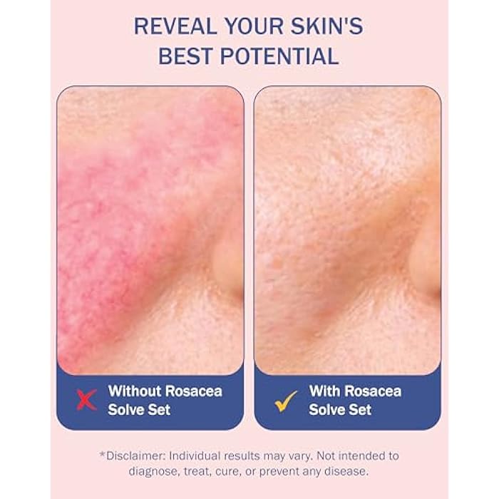 e70 Rosacea Treatment Skincare for Women & Men - Face Wash, Rosacea Cream & Face Serum, Moisturizer Redness Reducing Skin Care with Aloe Vera, Hyaluronic Acid & Fruit Extracts, Made in USA by e70 - Image 5