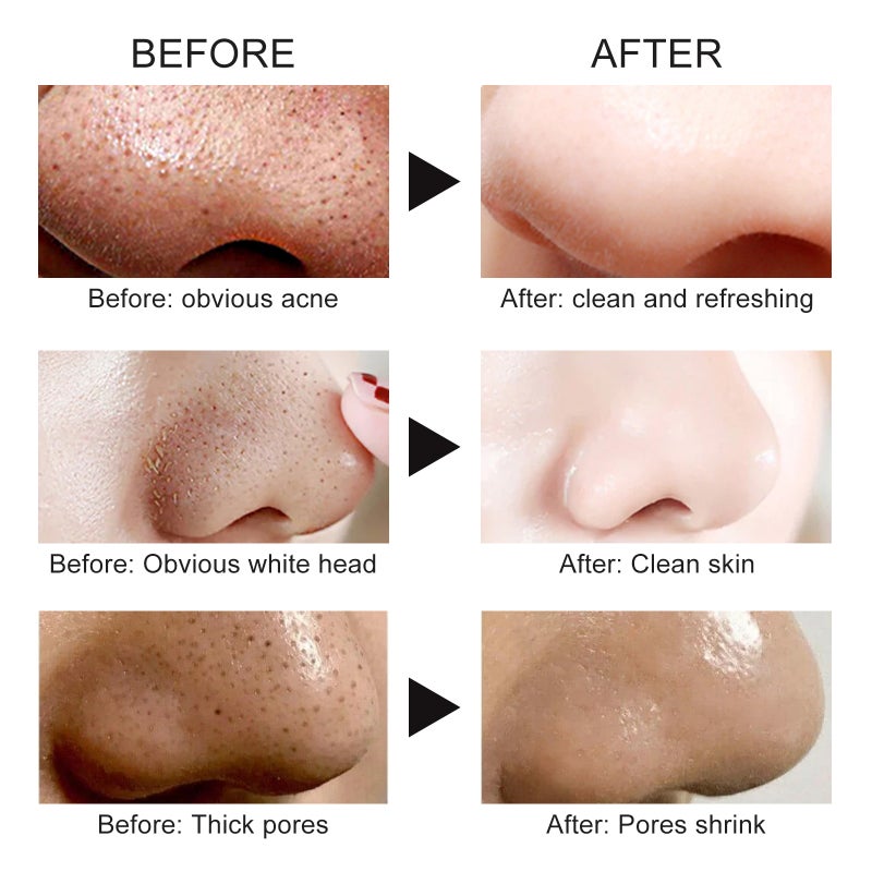 Blackhead Removal Stickers 10 Pcs Effective Pore Unclogging - Skin-Friendly Gentle Formula Blackhead Strips for All Skin Types & Nose Problem Areas - Image 5