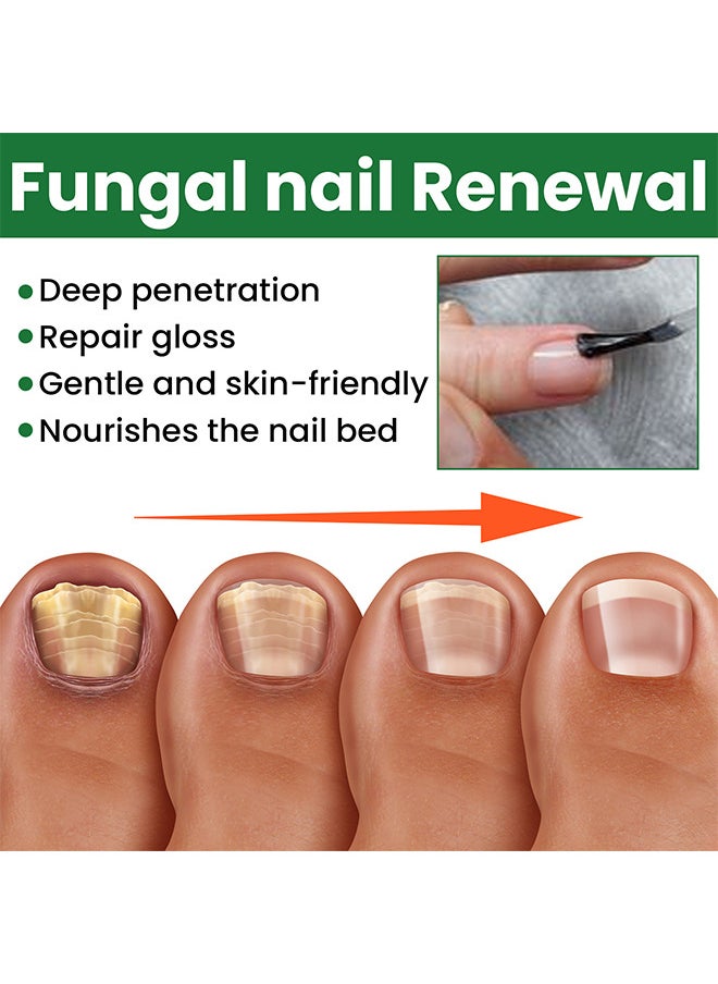EELHOE - Toenail Fungus Treatment Extra Strength, Fungal Nail Renewal Treatment For Toe Nail and Fingernails, Nail Repair Solution For Thick, Broken, Discolored Nails, Renews Damaged Cracked Ingrown Toenail - Image 1