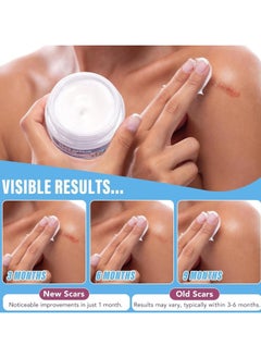 VOGSIG 50g Scar Removal Cream for Damaged Skin Surgery Scar Dead Skin Elimination Acne Scars Insect Bites and Pregnancy Lines Moisturizing and Skin Repair Reduce Scars and Mark Scar Repair Cream  - Image 2
