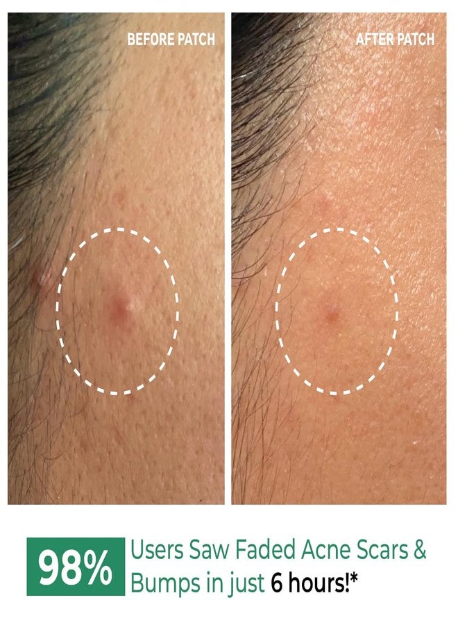 Conscious Chemist® Self Dissolving Microneedle Acne Patches (Pack of 8 Patches) | Painless & Effective Pimple Patches with 2% Salicylic Acid, Azelaic Acid & Niacinamide | Kills Bacteria, Reduces Redness, Scarring & Excess Sebum | Visible Results in 6 Hours - Image 1