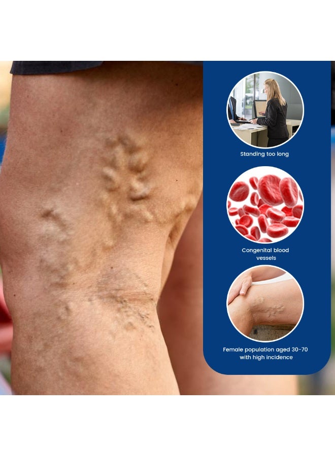 سوميفون مرهم الدوالي لتخفيف الدوالي وتحسين الدورة الدموية - Image 3