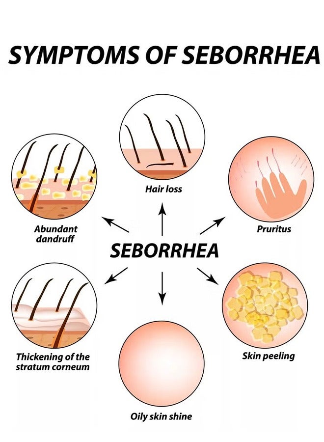 Sumifun Scalp care cream,cream For Scalp Prone To Folliculitis, Dermatitis, Dandruff, Mites, Itchy And Flaky Scalp, Treats Dandruff And Seborrheic Dermatitis - Image 3