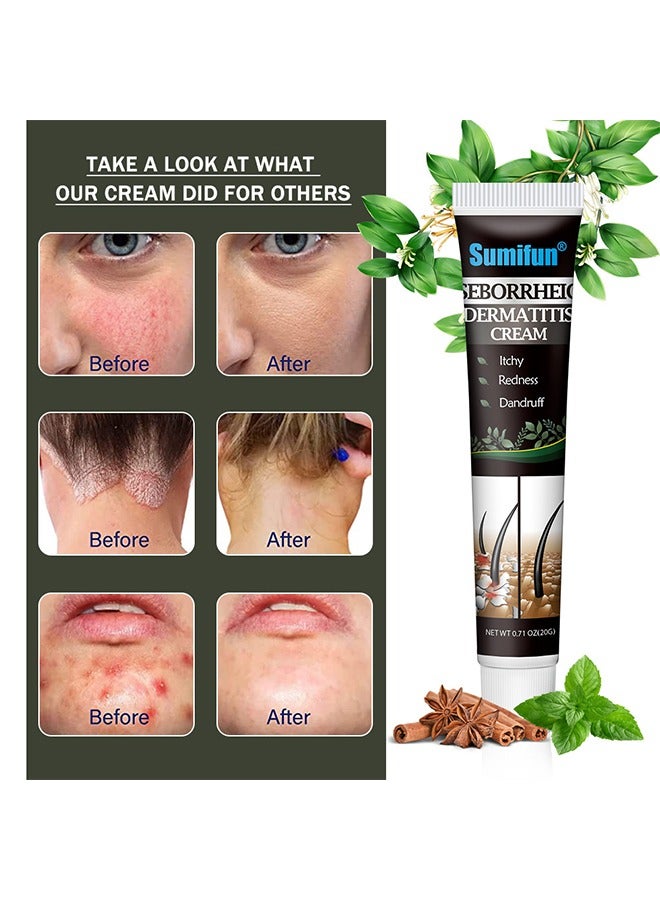 Sumifun Scalp care cream,cream For Scalp Prone To Folliculitis, Dermatitis, Dandruff, Mites, Itchy And Flaky Scalp, Treats Dandruff And Seborrheic Dermatitis - Image 4