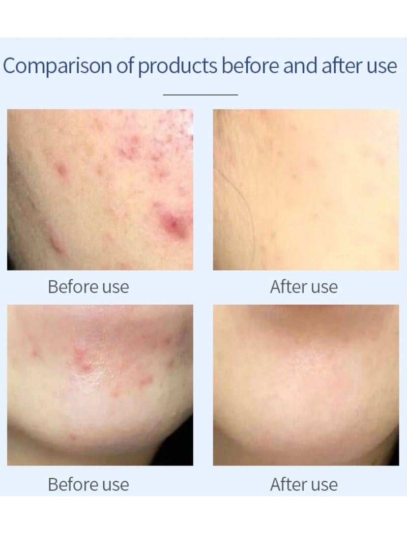 PUVIDA Acne Treatment Cream Acne Treatment Ointment Gel Adapalene Gel for Acne Treatment Gentle Moisturizing Acne Removing Gel Pimple and Acne Removal Anti Acne and Treatment Gel 20G - Image 4