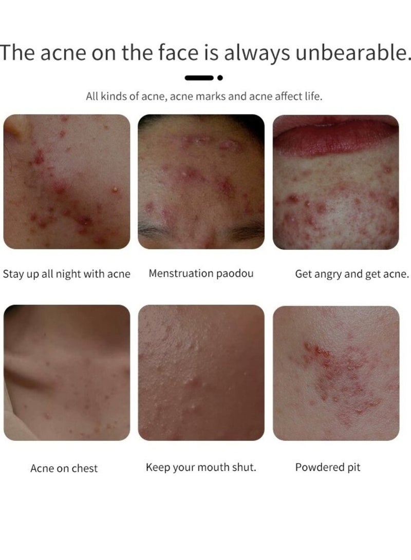 PUVIDA Acne Treatment Cream Acne Treatment Ointment Gel Adapalene Gel for Acne Treatment Gentle Moisturizing Acne Removing Gel Pimple and Acne Removal Anti Acne and Treatment Gel 20G - Image 5