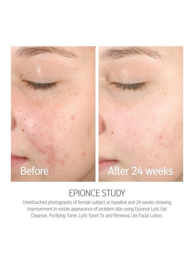 Epionce Renewal Lite Facial Lotion - Hydrating Face Moisturizer, Anti Aging & Dry Skin Barrier Repair Face Lotion, Glycerin Moisturizer for Oily Skin - Image 3