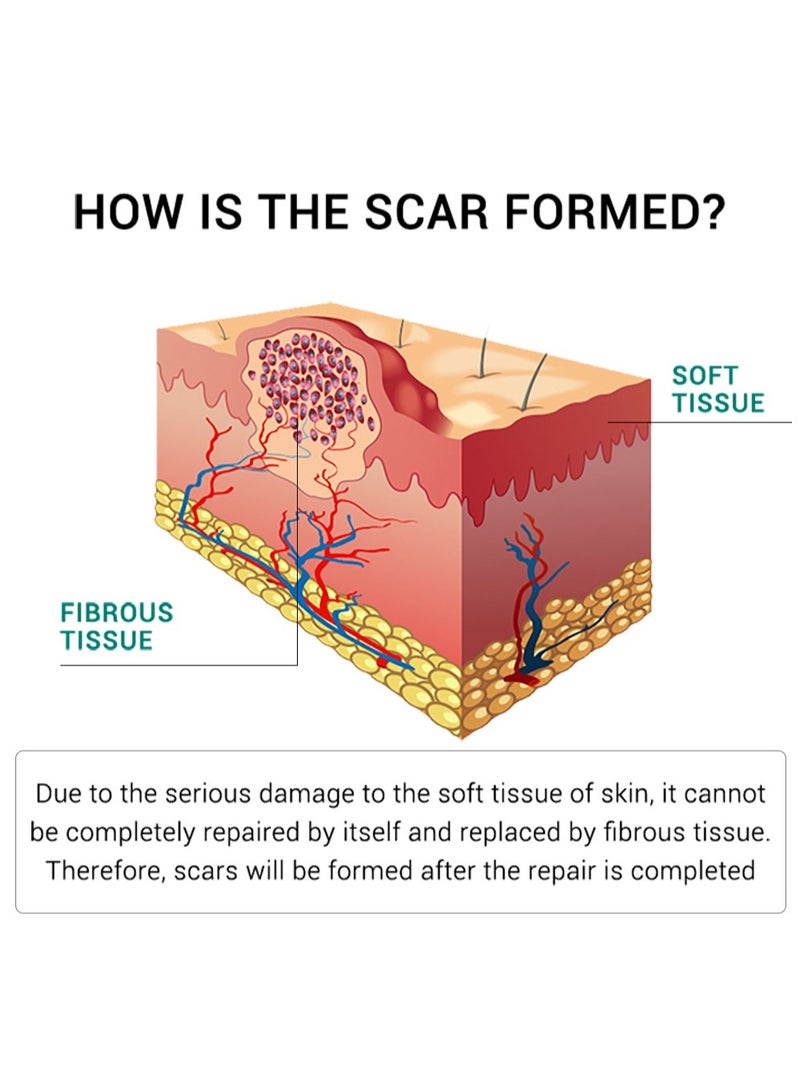 Breylee Acne Scar Cream Skin Repair Skin Care Scar Acne Treatment Whitening Cream - Image 4