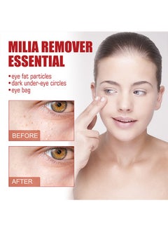 SOUTH MOON Milia Remover Essential 30ml, Milia Spot Removal Helps to Ruduce Milia, for Dark Circles Under Eye for Women, Anti Aging, Anti Wrinkle, Reduces Bags, Saggy Skin and Puffy Eyes, Eye Care  - Image 3