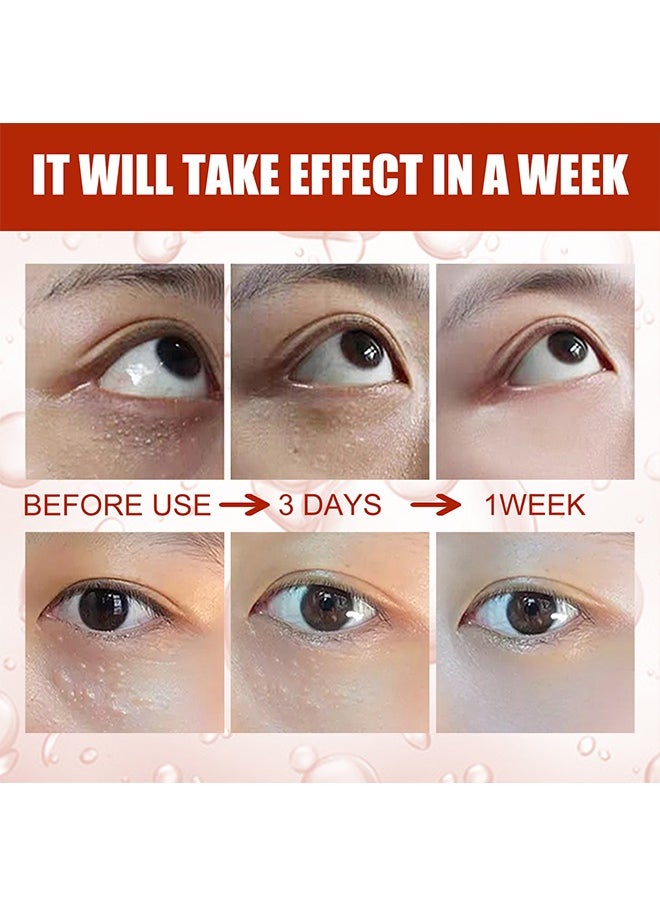 SOUTH MOON - Milia Remover Essential 30ml, Milia Spot Removal Helps to Ruduce Milia, for Dark Circles Under Eye for Women, Anti Aging, Anti Wrinkle, Reduces Bags, Saggy Skin and Puffy Eyes, Eye Care - Image 1