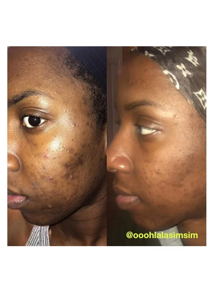 Carbon Theory Charcoal & Tea Tree Oil Breakout Control Facial Exfoliating Scrub