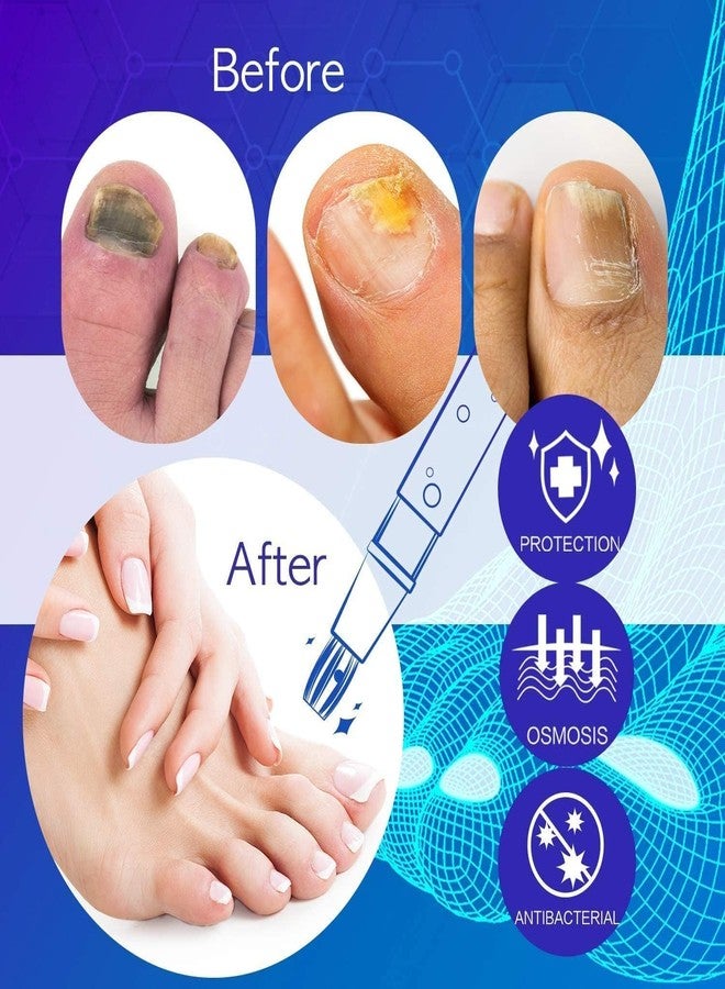 Neomen Nail Fungus Pen, Toenail Fungus Pen Treatment for Toenail & Fingernails, Fungal Nail Repair Pen For Nail Damage, Discoloration by Fungi - Image 5