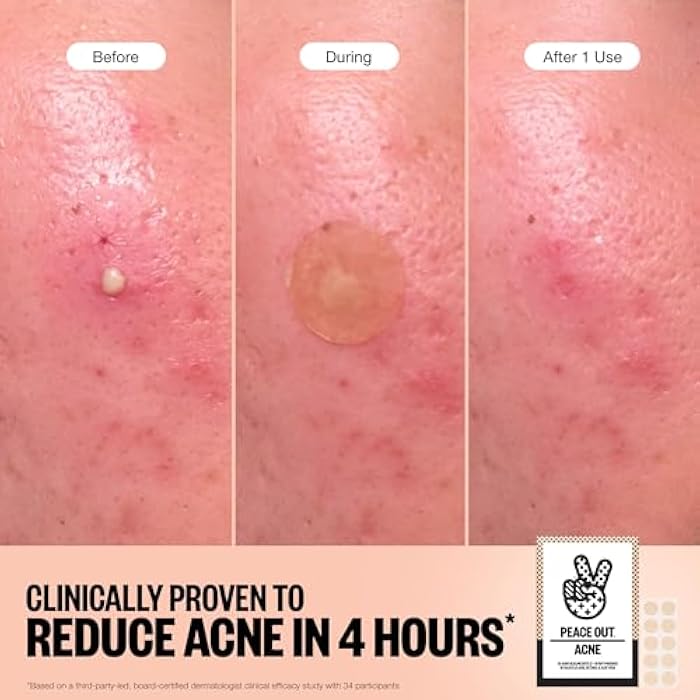 PEACE OUT Acne Healing Dots Helps Clear Blemishes Overnight, Fast Acting Hydrocolloid Pimple Patches for Breakouts with Salicylic Acid, Retinol and Aloe Vera, Award Winning Skincare Solution 20 Count - Image 3