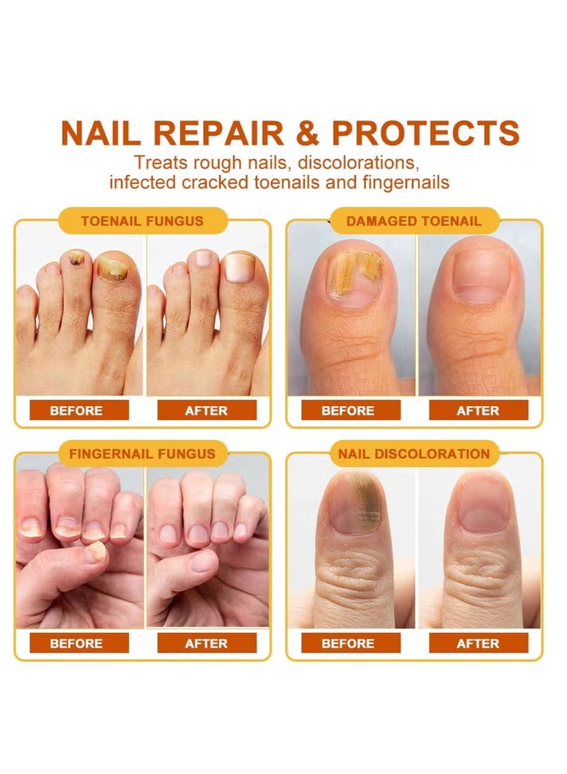 Sumifun Sumifun Bee Venom Nail Cream Nail Remover Nail Remover New Brightening Plaster  - Image 4