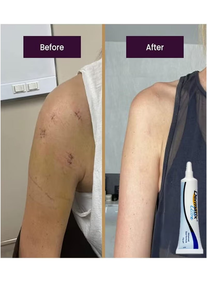 Dermatix جل متقدم للندبات 15 جرام لتحسين مظهر الندبات، يجف بسرعة وتركيبة جل سيليكون فريدة، يستخدم لعلاج الكيلويد والندبات الجراحية والندبات الضخامية، مناسب للبشرة الحساسة - Image 3