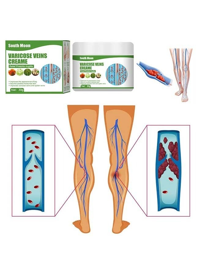 SOUTH MOON - Varicose Veins Cream to Relieve Phlebitis Angiitis, Strengthen Capillary Health, Relieve Swelling Pain and Fatigue, Minimize Varicose Vein and Spider Vein Leg Care Massage Cream 30g - Image 1