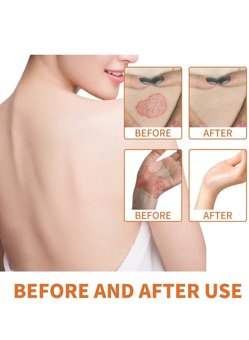 وييون  سم النحل كريم علاج الصدفية 30g - Image 4